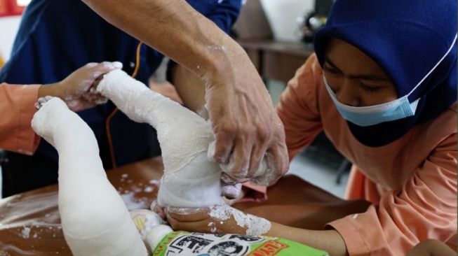 Program MENTARI Clubfoot berfokus pada pendampingan anak dengan kaki pengkor. (ist)